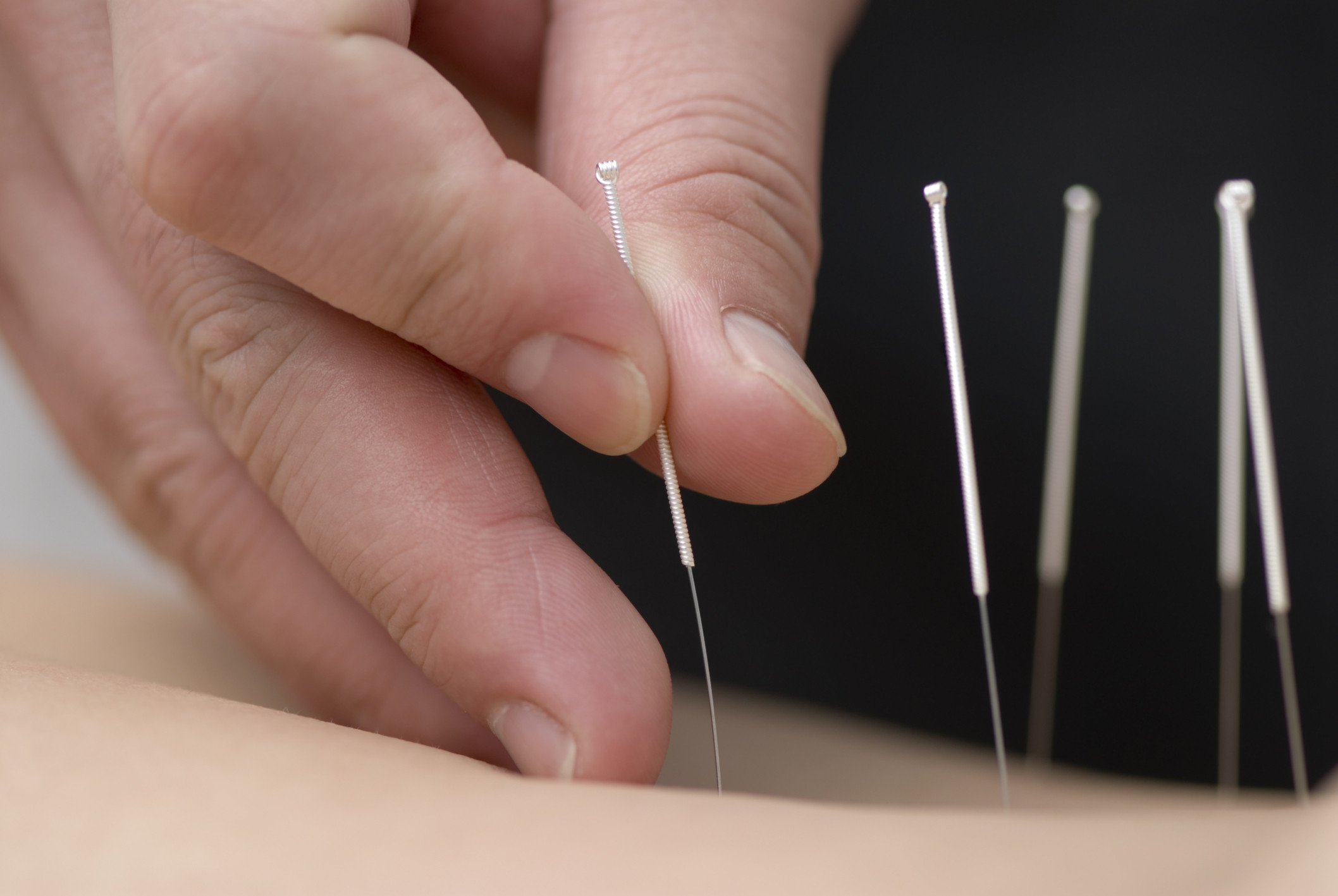 acupuncture Gold Coast